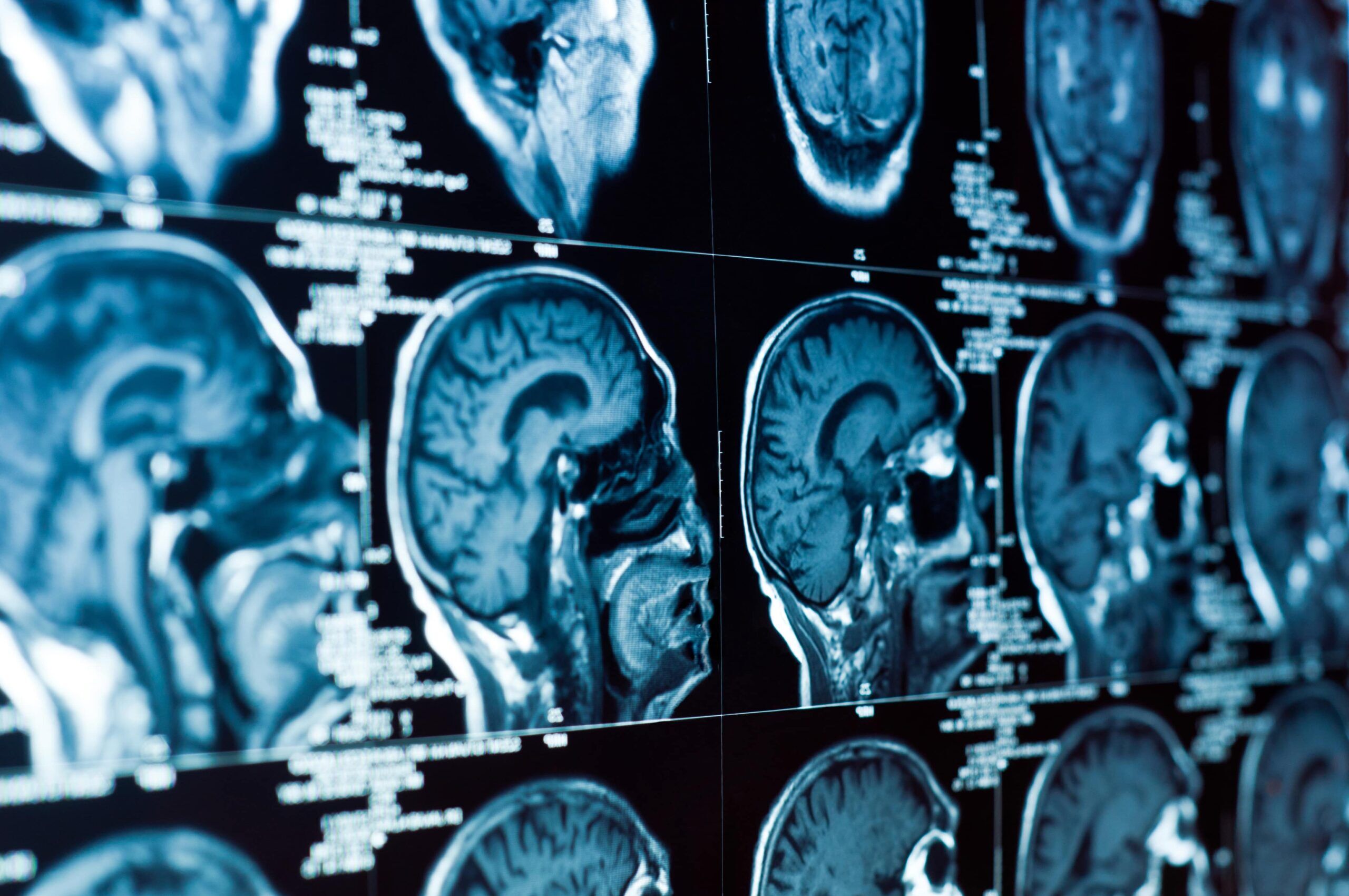 Brain Injury Lawyer Tarzana, CA