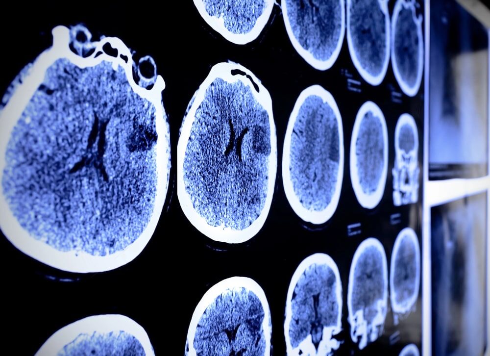 brain injury lawyer Tarzana, CA